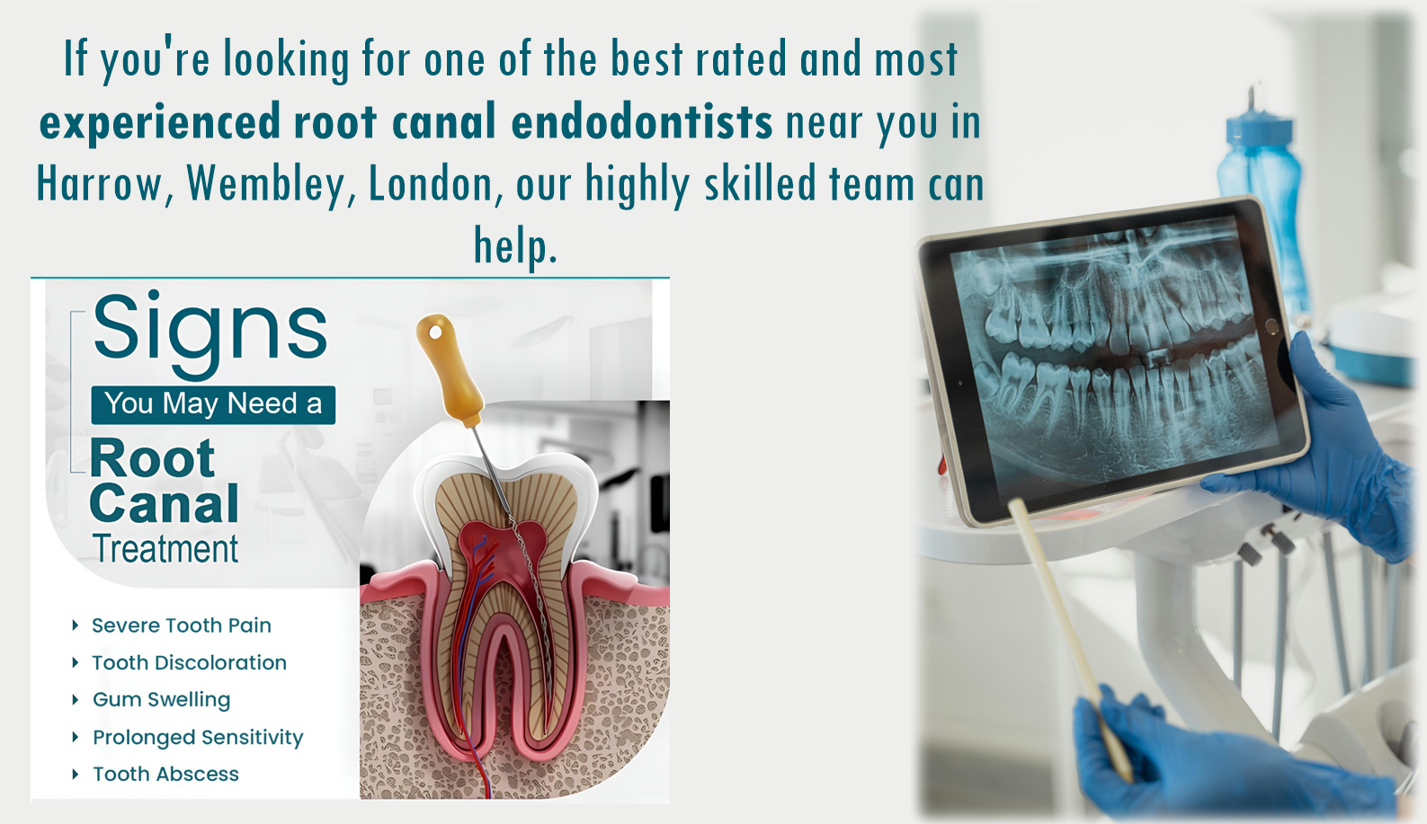 Endodontist Near Me Wembley, Harrow Endodontist Near Me Wembley, Harrow
